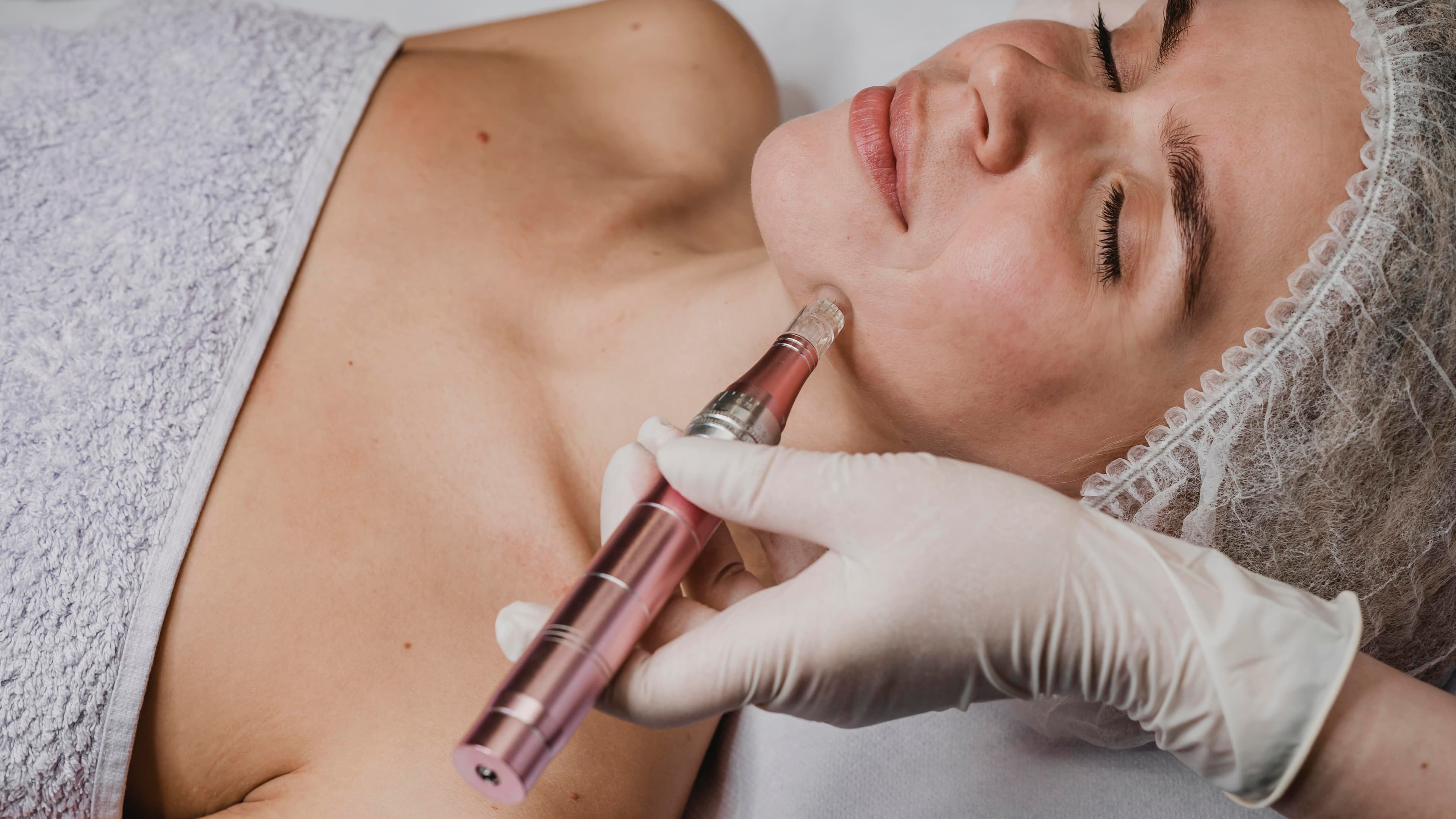 Illustration de Microneedling